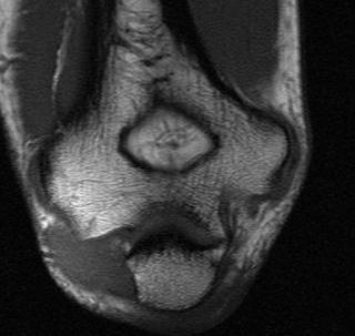 Ulna Nerve MRI Cubital Tunnel